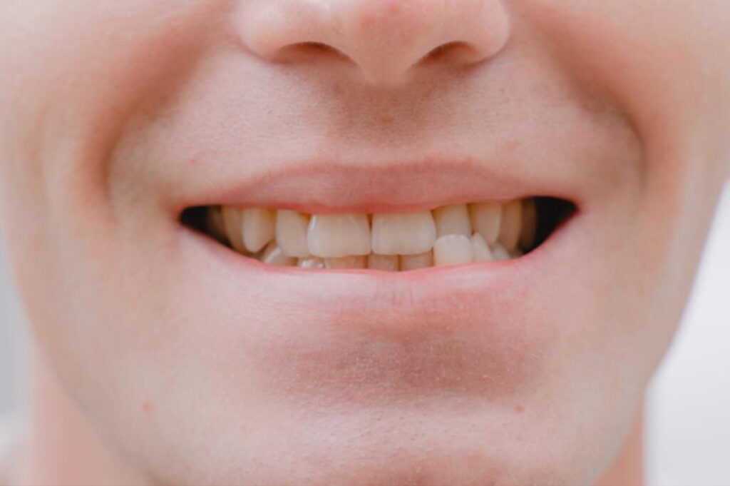 gebitslijtage-dental-art