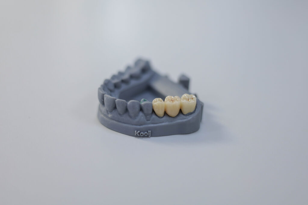 kronen-en-bruggen-dental-art